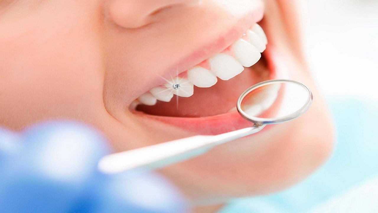 Răng gắn kim cương – Đẳng cấp mới cho hàm răng của bạn